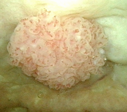 Urologie Amriswil: Grosser Blasentumor am Blasendach 