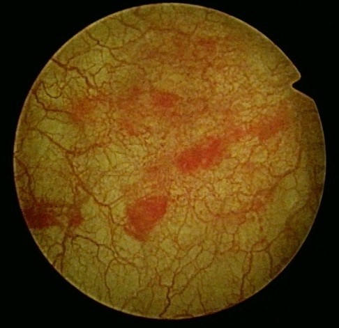 Flacher Blasenkrebs, sogenannter Carcinoma in situ.
