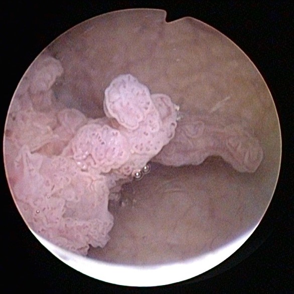 Blasenkrebs korralenförmig (Quelle: Urologie_Amriswil)