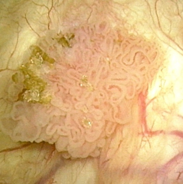 Blasenkrebs breit-korallenförmig (Quelle: Urologie_Amriswil)