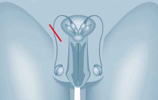 Urologie_Amriswil_Schnittführung bei Samentrangdenervierung
